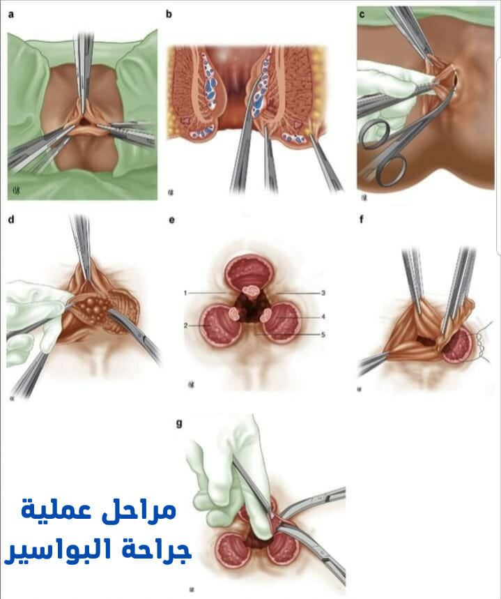 مراحل جراحة البواسير
